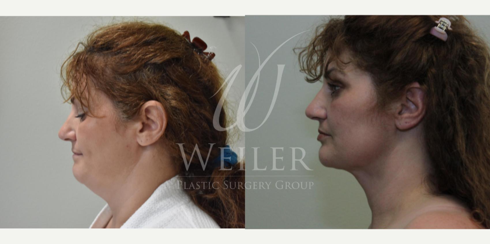 Before & After Submental Liposuction Case 250 View #1 View in Baton Rouge, New Orleans, & Lafayette, Louisiana
