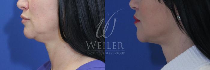 Before & After Submental Liposuction Case 537 Left Side View in Baton Rouge, New Orleans, & Lafayette, Louisiana