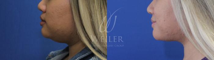 Before & After Submental Liposuction Case 748 Left Side View in Baton Rouge, New Orleans, & Lafayette, Louisiana
