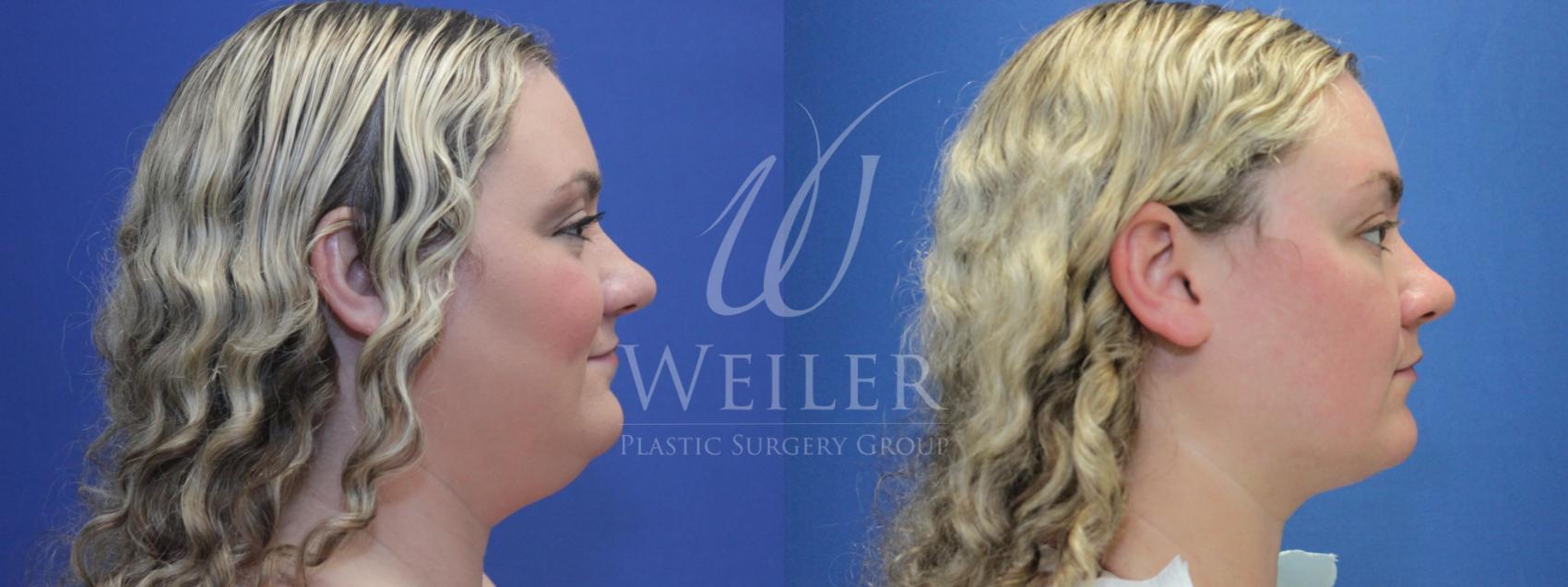 Before & After Submental Liposuction Case 751 Right Side View in Baton Rouge, New Orleans, & Lafayette, Louisiana