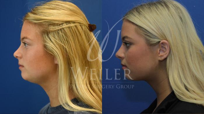 Before & After Submental Liposuction Case 800 Left Side View in Baton Rouge, New Orleans, & Lafayette, Louisiana