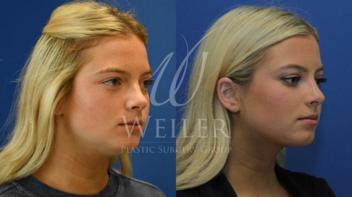 Before & After Submental Liposuction Case 800 Right Oblique View in Baton Rouge, New Orleans, & Lafayette, Louisiana