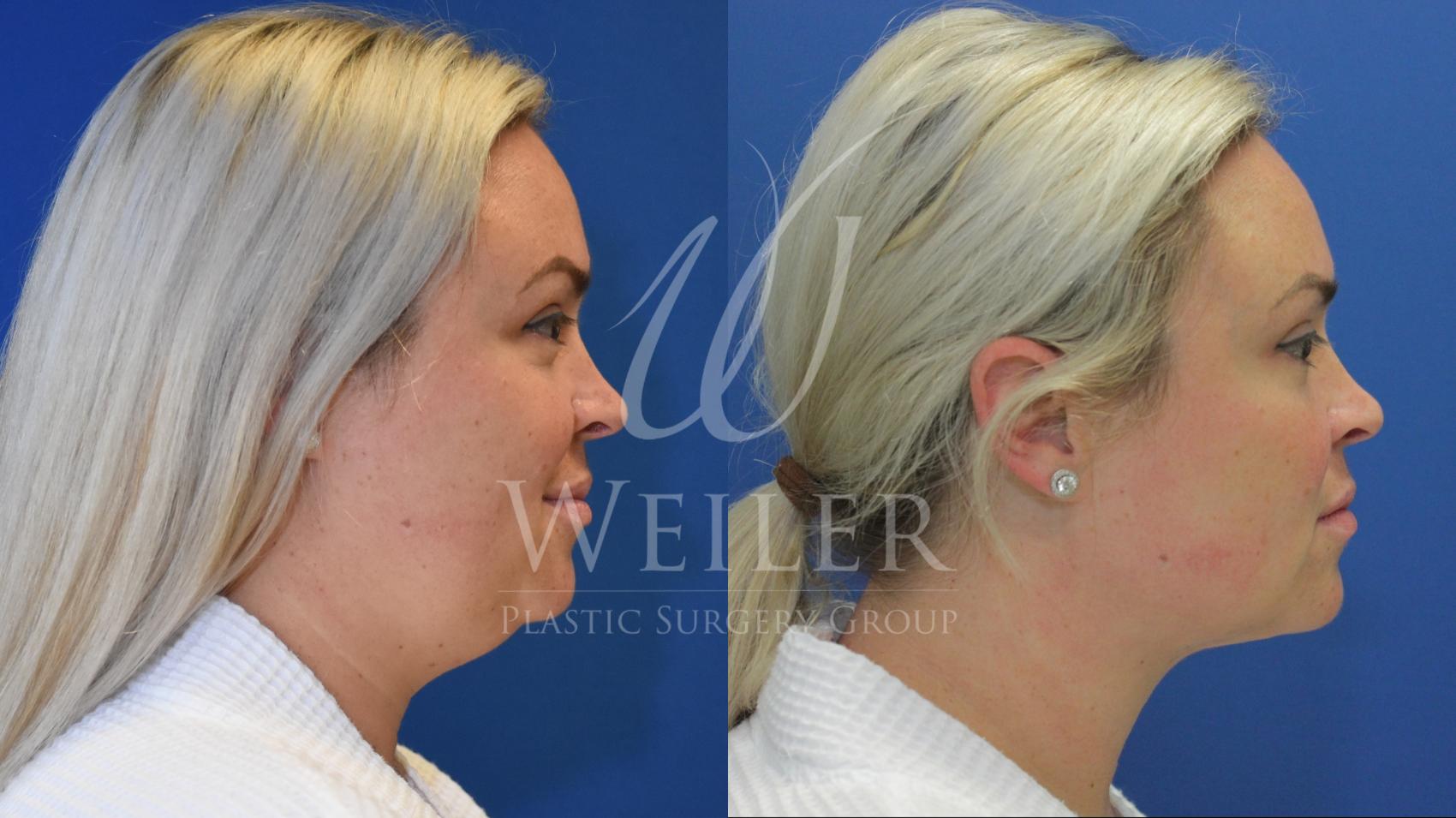 Before & After Submental Liposuction Case 815 Right Side View in Baton Rouge, New Orleans, & Lafayette, Louisiana