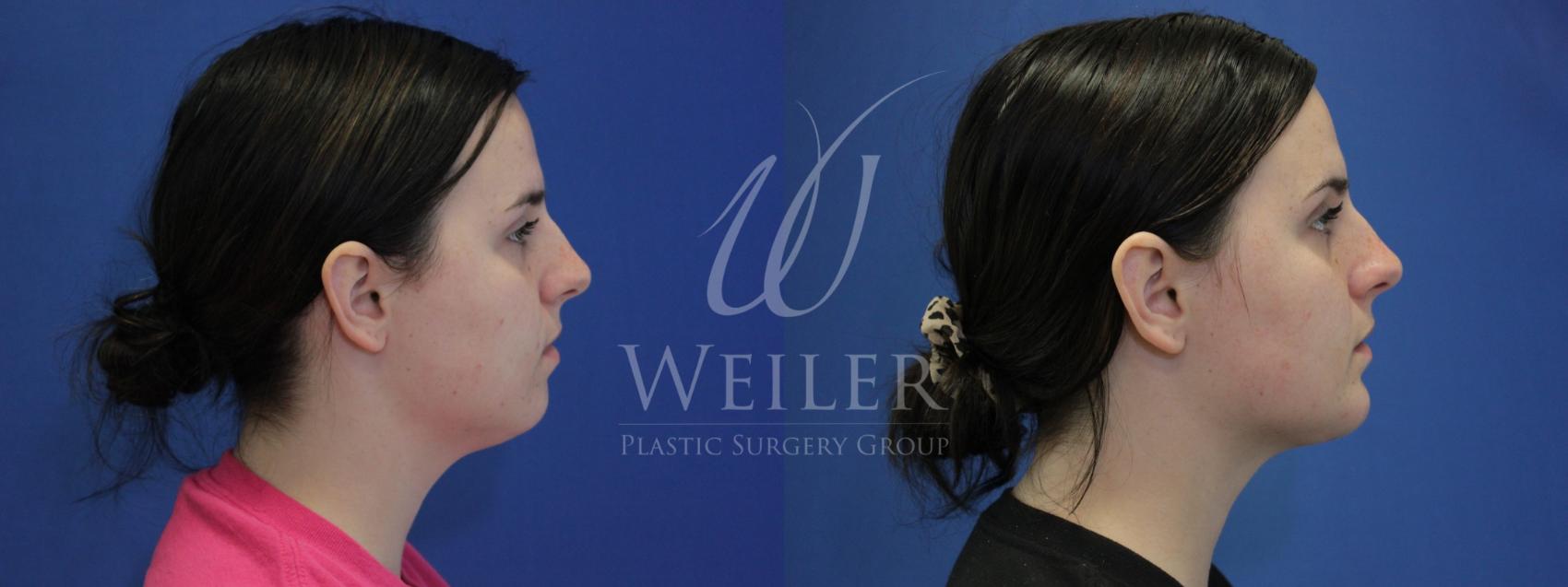 Before & After Submental Liposuction Case 863 Right Side View in Baton Rouge, New Orleans, & Lafayette, Louisiana