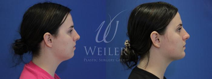 Before & After Submental Liposuction Case 863 Right Side View in Baton Rouge, New Orleans, & Lafayette, Louisiana