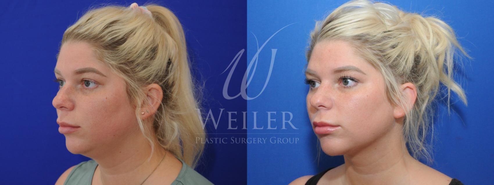 Before & After Submental Liposuction Case 909 Left Oblique View in Baton Rouge, New Orleans, & Lafayette, Louisiana