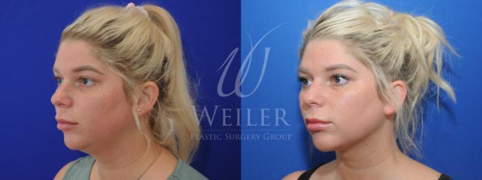 Before & After Submental Liposuction Case 909 Left Oblique View in Baton Rouge, New Orleans, & Lafayette, Louisiana
