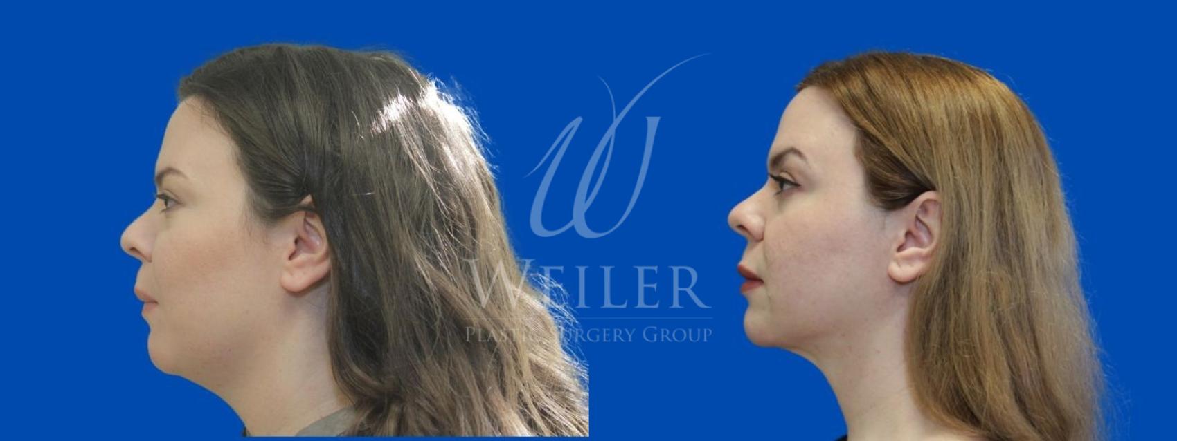 Before & After Submental Liposuction Case 938 Left Side View in Baton Rouge, New Orleans, & Lafayette, Louisiana