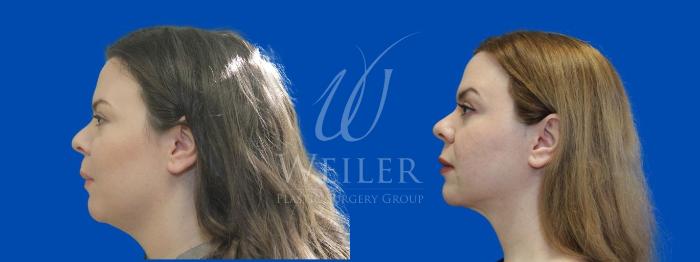 Before & After Submental Liposuction Case 938 Left Side View in Baton Rouge, New Orleans, & Lafayette, Louisiana