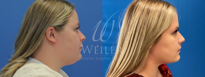 Before & After Submental Liposuction Case 953 Right Oblique View in Baton Rouge, New Orleans, & Lafayette, Louisiana