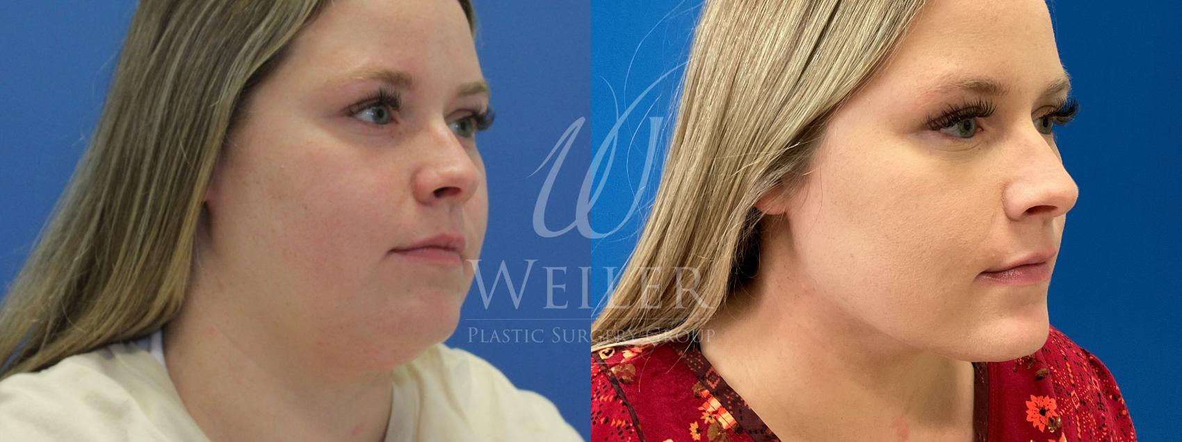 Before & After Submental Liposuction Case 953 Right Side View in Baton Rouge, New Orleans, & Lafayette, Louisiana