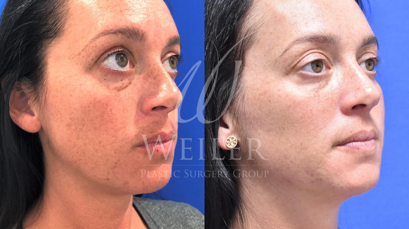 Before & After JUVÉDERM® Case 603 Right Oblique View in Baton Rouge, Louisiana