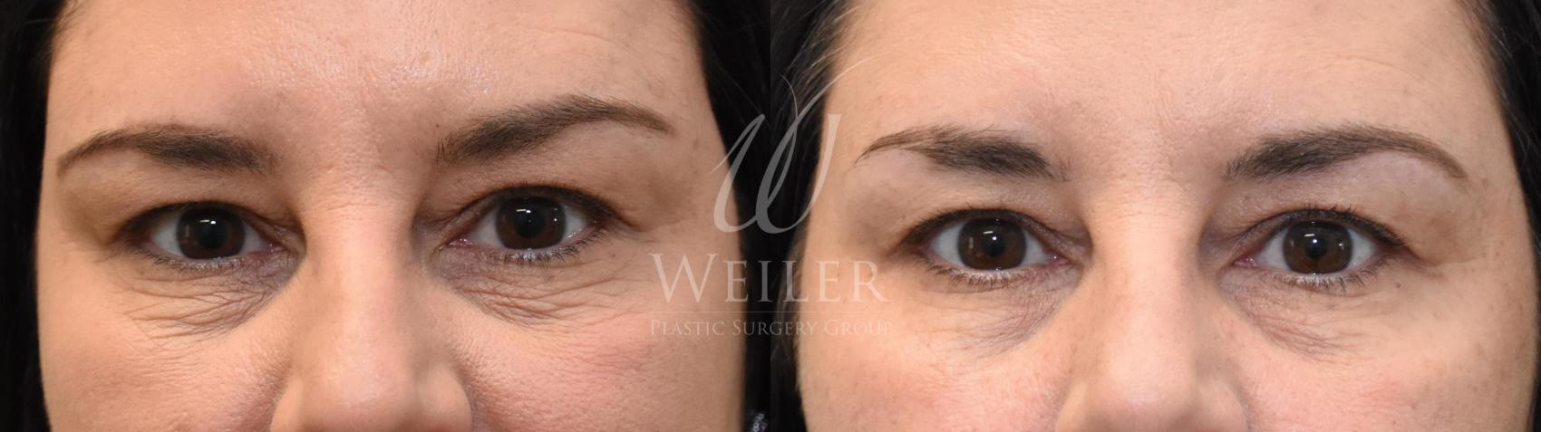 ThermiSmooth Wrinkle Reduction Baton Rouge Hammond New Orleans