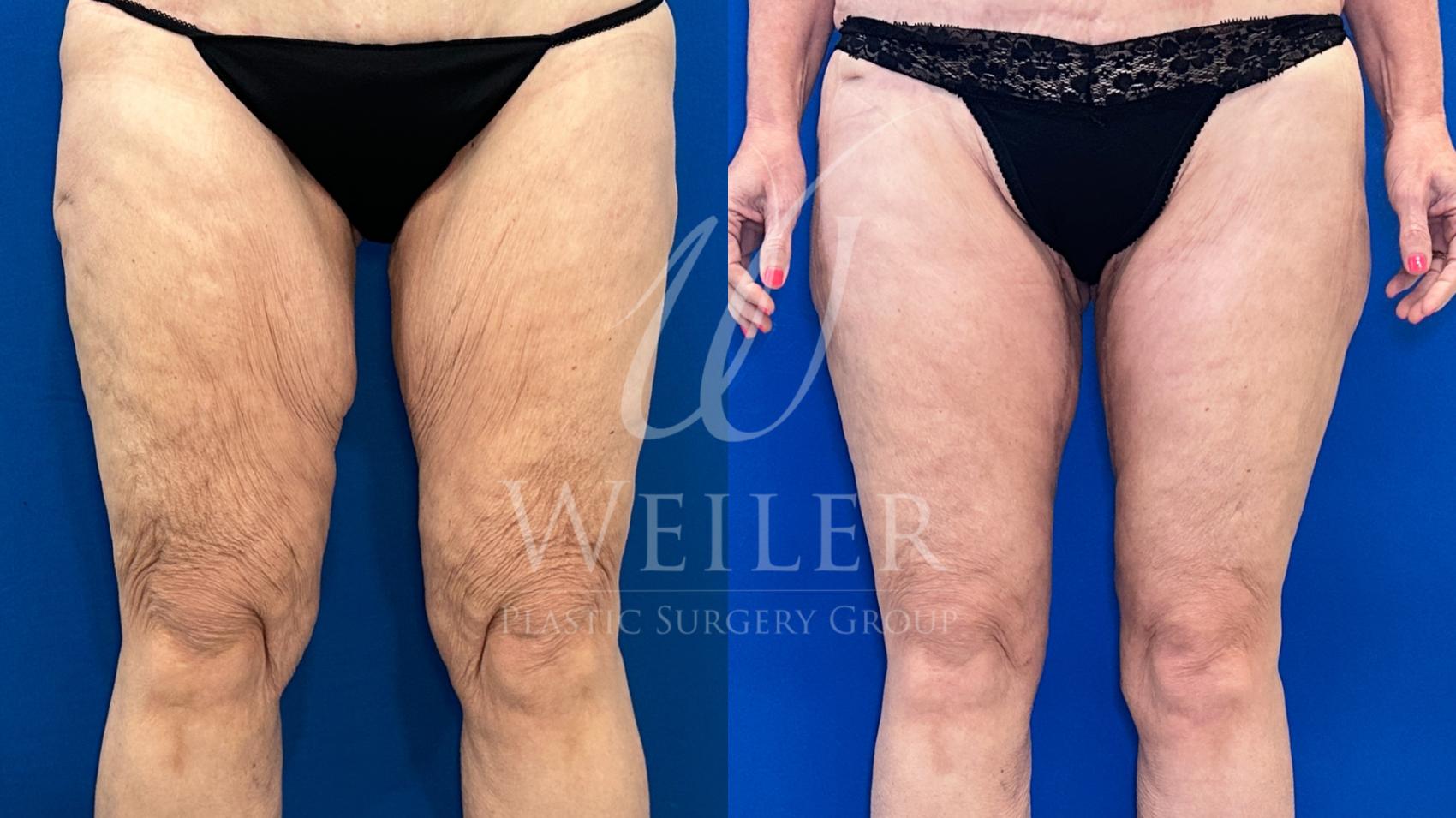 Before & After Thigh Lift Case 1315 Front View in Baton Rouge, New Orleans, & Lafayette, Louisiana