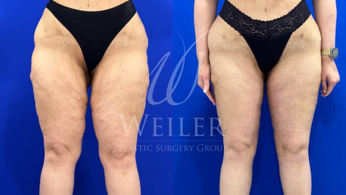 Before & After Thigh Lift Case 1661 Front View in Baton Rouge, New Orleans, & Lafayette, Louisiana
