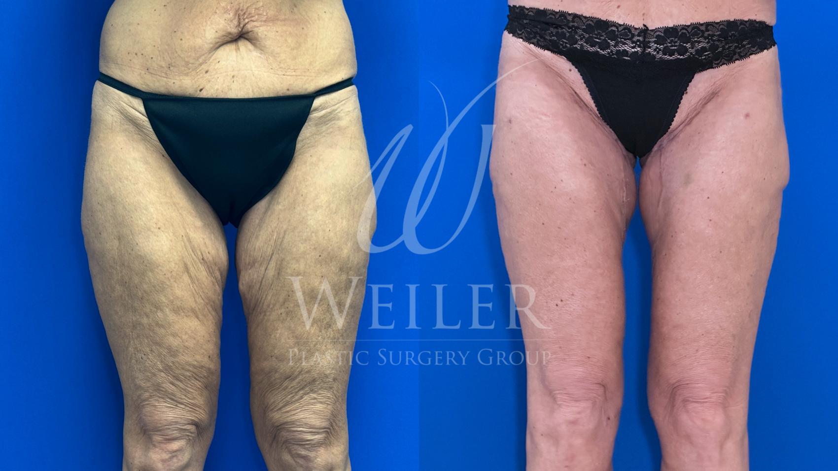 Before & After Thigh Lift Case 1662 Front View in Baton Rouge, New Orleans, & Lafayette, Louisiana
