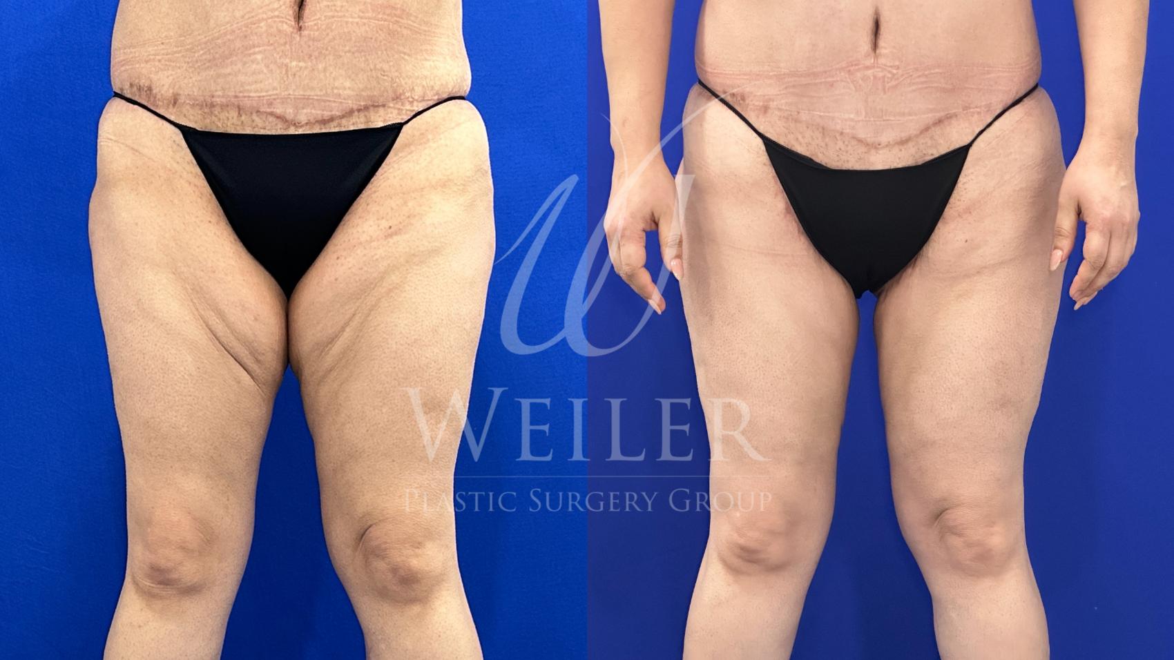 Before & After Thigh Lift Case 1663 Front View in Baton Rouge, New Orleans, & Lafayette, Louisiana