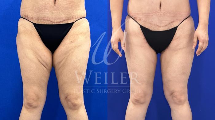 Before & After Thigh Lift Case 1663 Front View in Baton Rouge, New Orleans, & Lafayette, Louisiana