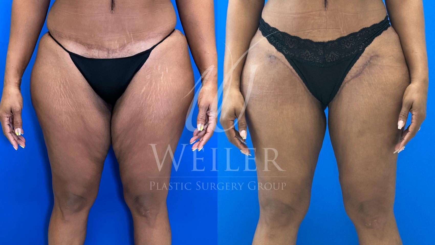 Before & After Thigh Lift Case 1664 Front View in Baton Rouge, New Orleans, & Lafayette, Louisiana