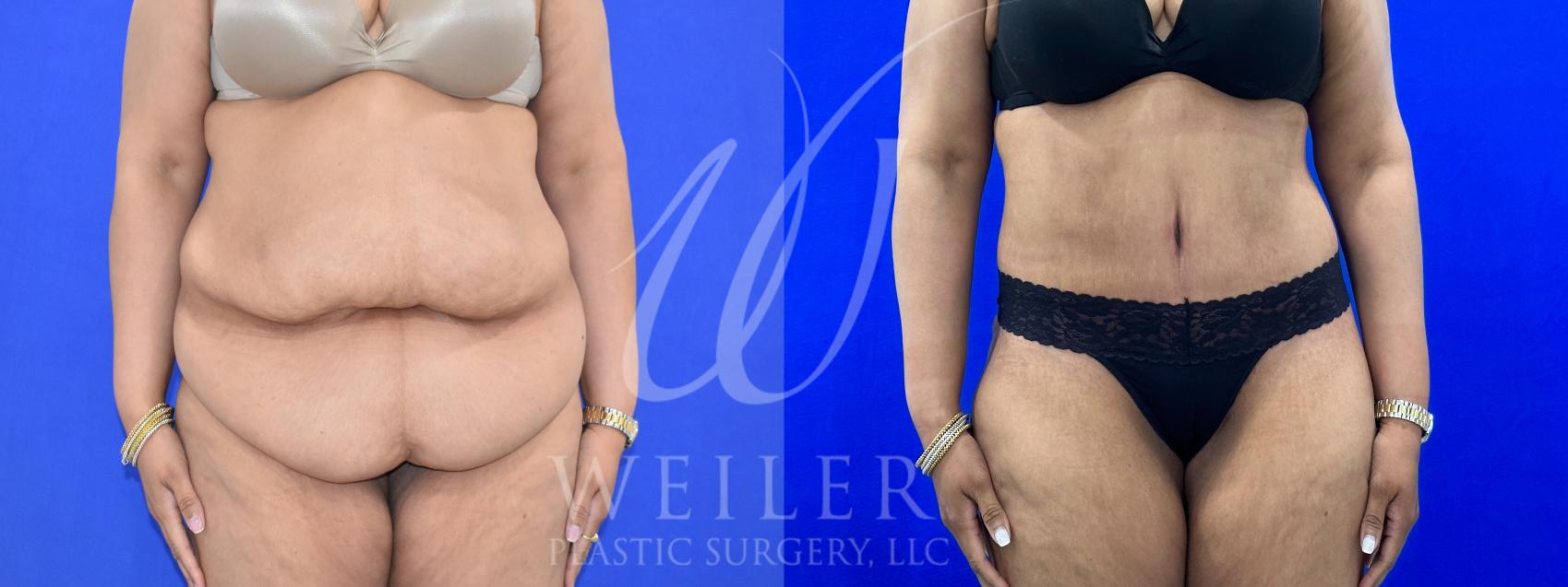 Before & After Tummy Tuck Case 1000 Front View in Baton Rouge, Louisiana