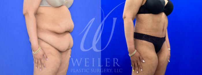 Before & After Tummy Tuck Case 1000 Right Oblique View in Baton Rouge, New Orleans, & Lafayette, Louisiana