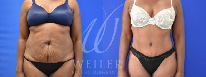 Before & After Tummy Tuck Case 1003 Front View in Baton Rouge, New Orleans, & Lafayette, Louisiana