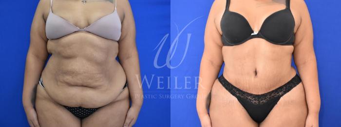 Before & After Tummy Tuck Case 1013 Front View in Baton Rouge, New Orleans, & Lafayette, Louisiana