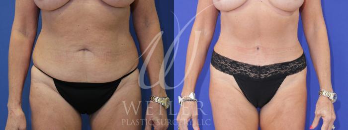 Before & After Tummy Tuck Case 1025 Front View in Baton Rouge, New Orleans, & Lafayette, Louisiana