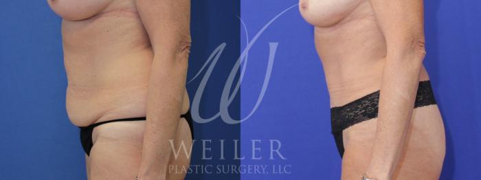 Before & After Tummy Tuck Case 1025 Left Side View in Baton Rouge, New Orleans, & Lafayette, Louisiana