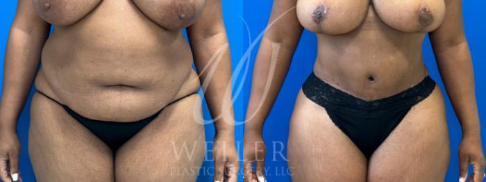 Before & After Tummy Tuck Case 1042 Front View in Baton Rouge, New Orleans, & Lafayette, Louisiana