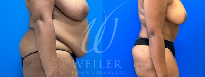 Before & After Tummy Tuck Case 1042 Right Side View in Baton Rouge, New Orleans, & Lafayette, Louisiana
