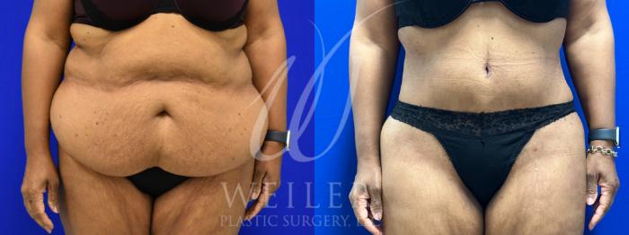 Before & After Tummy Tuck Case 1048 Front View in Baton Rouge, New Orleans, & Lafayette, Louisiana
