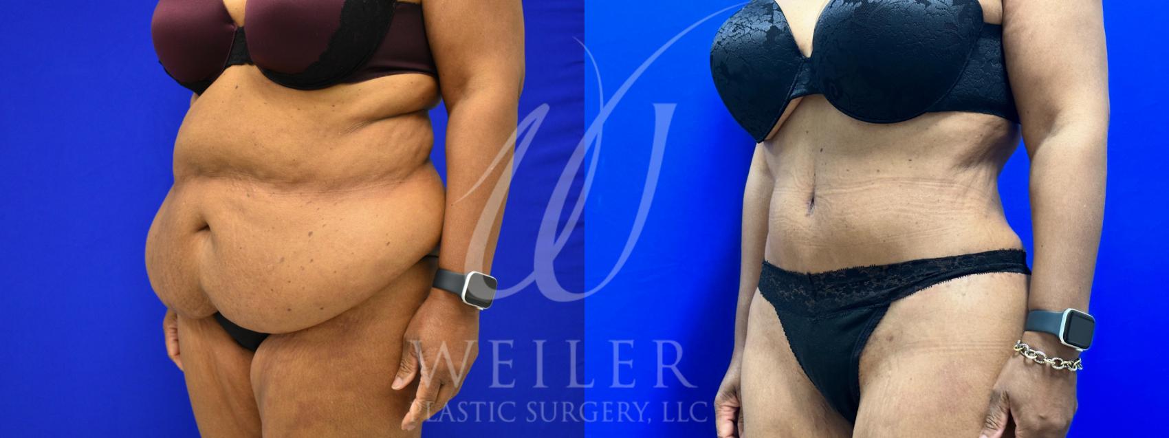 Before & After Tummy Tuck Case 1048 Left Oblique View in Baton Rouge, New Orleans, & Lafayette, Louisiana