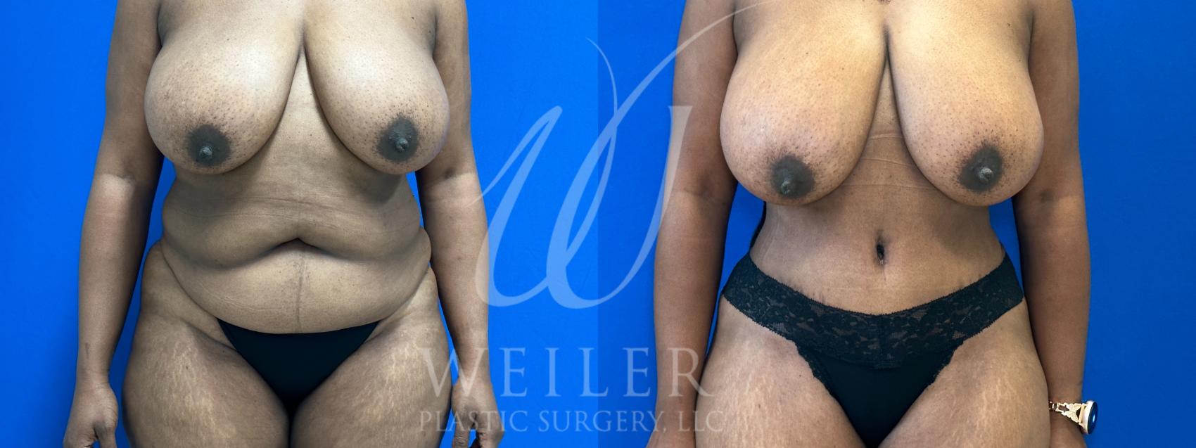 Before & After Tummy Tuck Case 1049 Front View in Baton Rouge, New Orleans, & Lafayette, Louisiana