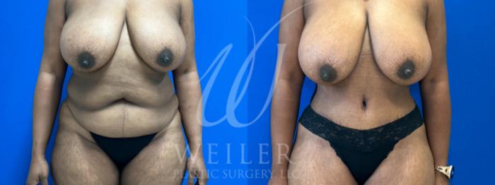 Before & After Tummy Tuck Case 1049 Front View in Baton Rouge, New Orleans, & Lafayette, Louisiana