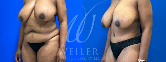 Before & After Tummy Tuck Case 1049 Left Oblique View in Baton Rouge, New Orleans, & Lafayette, Louisiana
