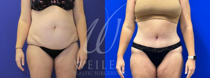 Before & After Tummy Tuck Case 1051 Front View in Baton Rouge, New Orleans, & Lafayette, Louisiana