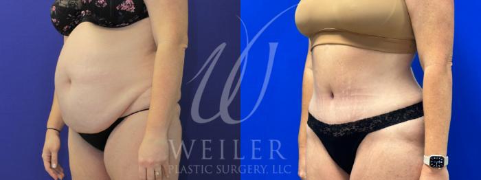 Before & After Tummy Tuck Case 1051 Left Oblique View in Baton Rouge, New Orleans, & Lafayette, Louisiana