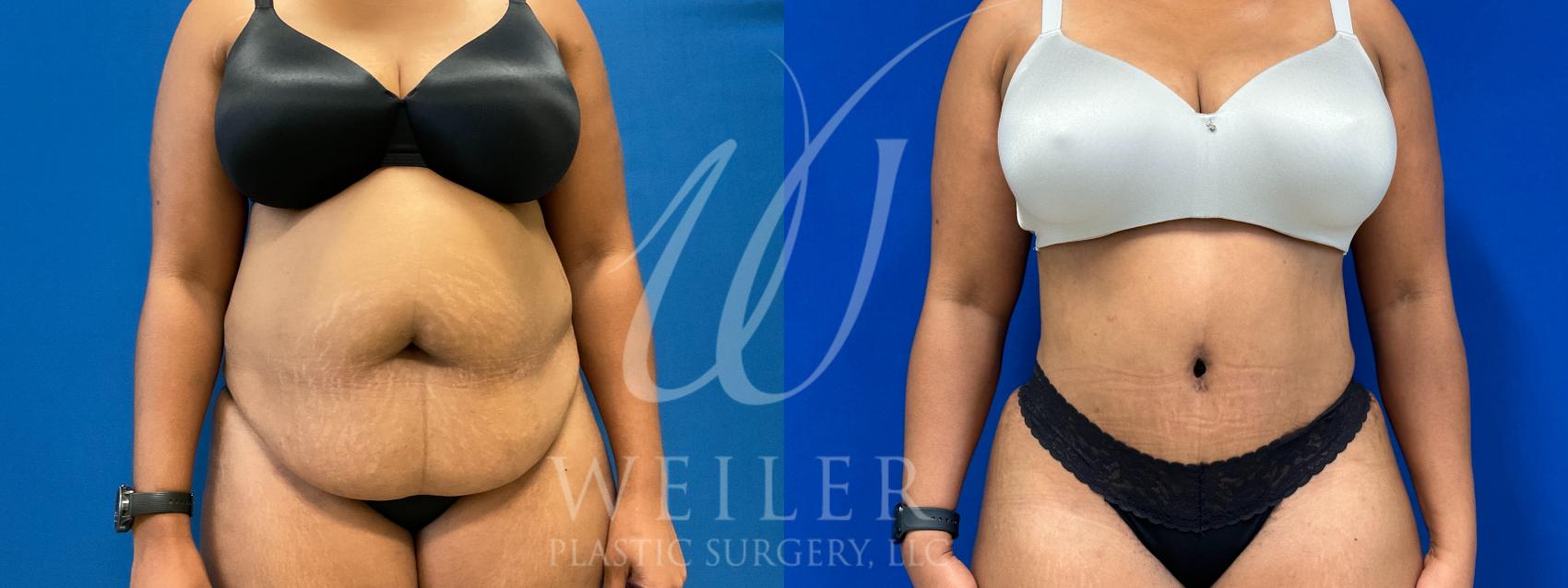 Liposuction for Bra Roll Removal  Mandeville & New Orleans, LA