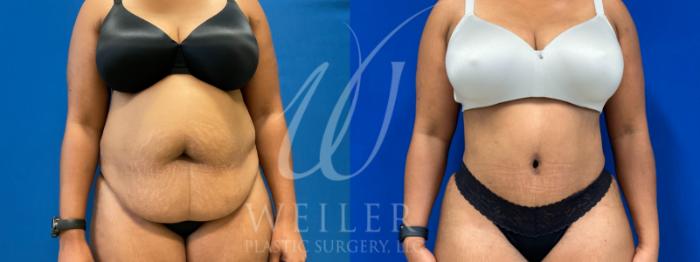 Before & After Tummy Tuck Case 1079 Front View in Baton Rouge, New Orleans, & Lafayette, Louisiana