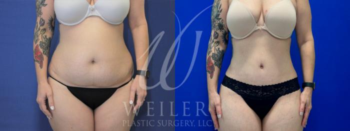 Before & After Tummy Tuck Case 1086 Front View in Baton Rouge, New Orleans, & Lafayette, Louisiana
