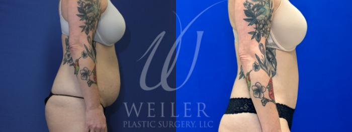 Before & After Tummy Tuck Case 1086 Right Side View in Baton Rouge, New Orleans, & Lafayette, Louisiana