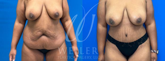 Before & After Tummy Tuck Case 1091 Front View in Baton Rouge, New Orleans, & Lafayette, Louisiana
