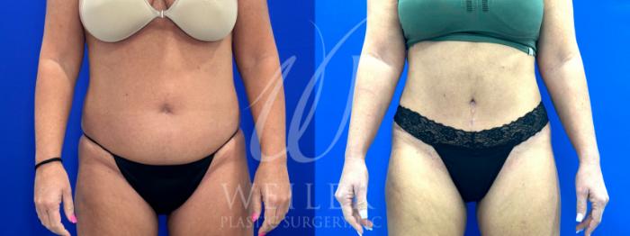 Before & After Tummy Tuck Case 1108 Front View in Baton Rouge, New Orleans, & Lafayette, Louisiana