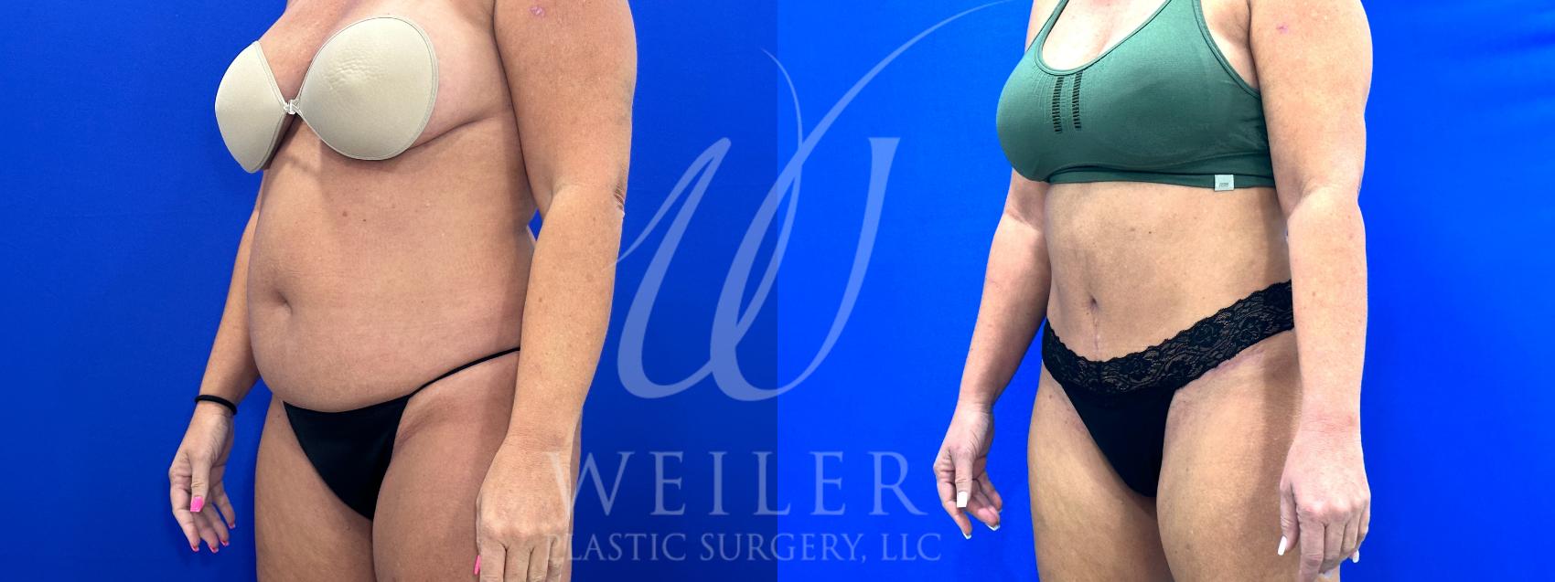 Before & After Tummy Tuck Case 1108 Left Oblique View in Baton Rouge, New Orleans, & Lafayette, Louisiana