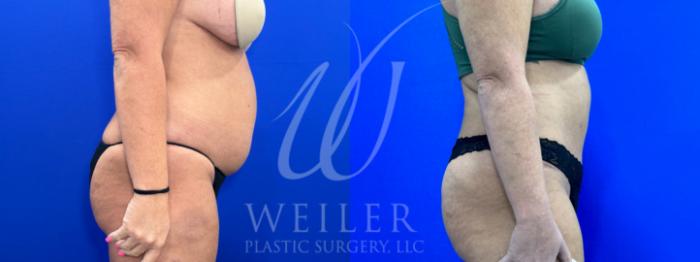 Before & After Tummy Tuck Case 1108 Right Side View in Baton Rouge, New Orleans, & Lafayette, Louisiana
