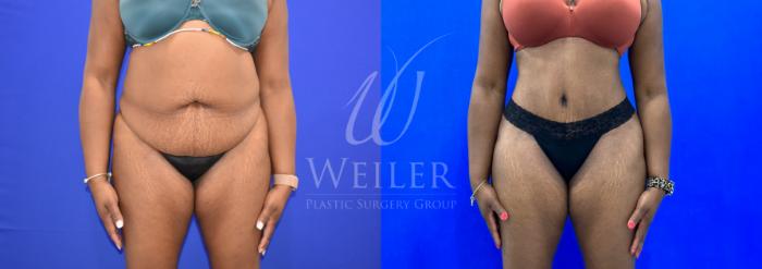 Before & After Tummy Tuck Case 1110 Front View in Baton Rouge, New Orleans, & Lafayette, Louisiana