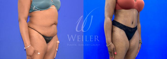 Before & After Tummy Tuck Case 1110 Right Oblique View in Baton Rouge, New Orleans, & Lafayette, Louisiana