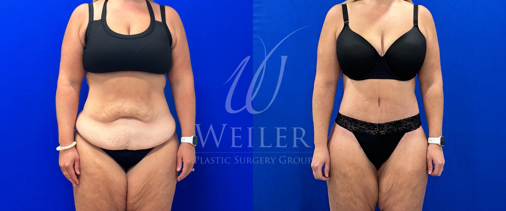 Before & After Tummy Tuck Case 1112 Front View in Baton Rouge, New Orleans, & Lafayette, Louisiana