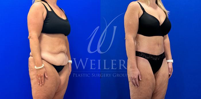 Before & After Tummy Tuck Case 1112 Right Oblique View in Baton Rouge, New Orleans, & Lafayette, Louisiana